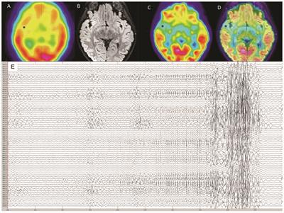 Case Report: Aperiodic Fluctuations of Neural Activity in the Ictal MEG of a Child With Drug-Resistant Fronto-Temporal Epilepsy